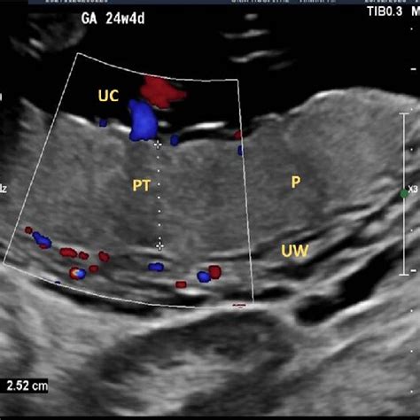 how to measure placental thickness|placental thickness normal range.